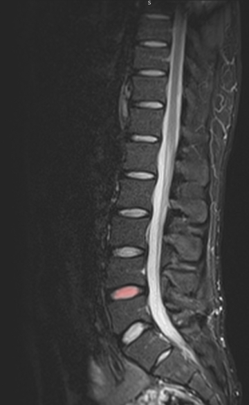 MRI of lumbar spine